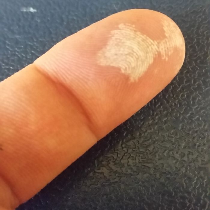 Dedo com uma mancha esbranquiçada na ponta